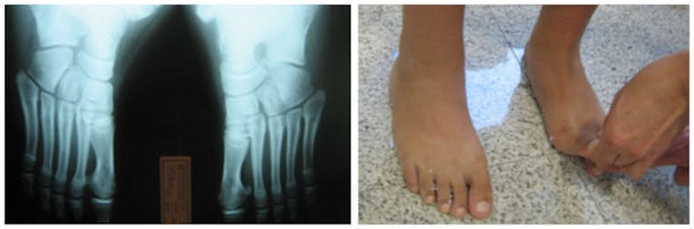 Πλατυποδία