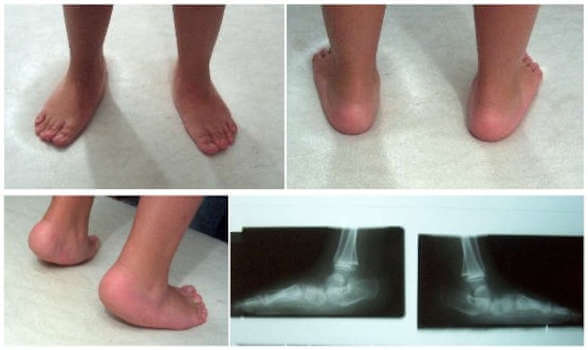 Πλατυποδία