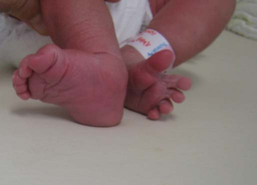 Βλαισότητα άκρου πόδα