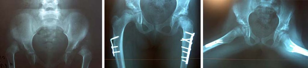 Χειρουργική δυσπλαστικού ισχίου