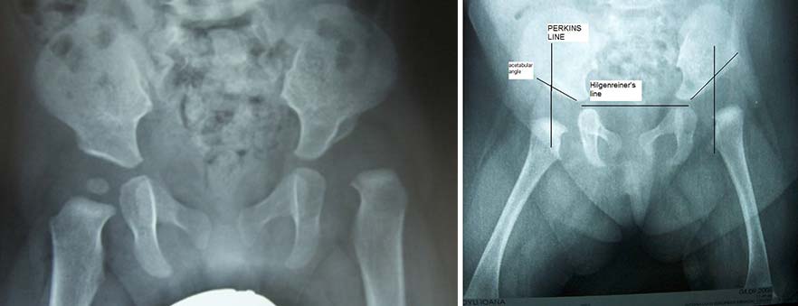 Υπερηχογράφημα βρεφικού ισχίου