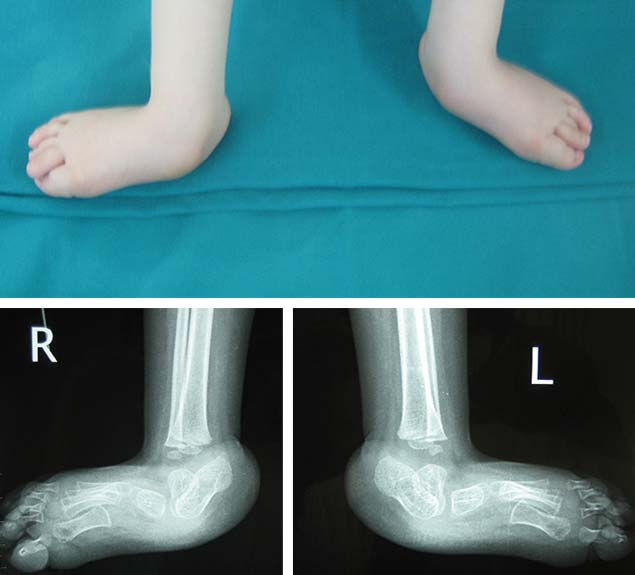 Βλαισότητα άκρου πόδα