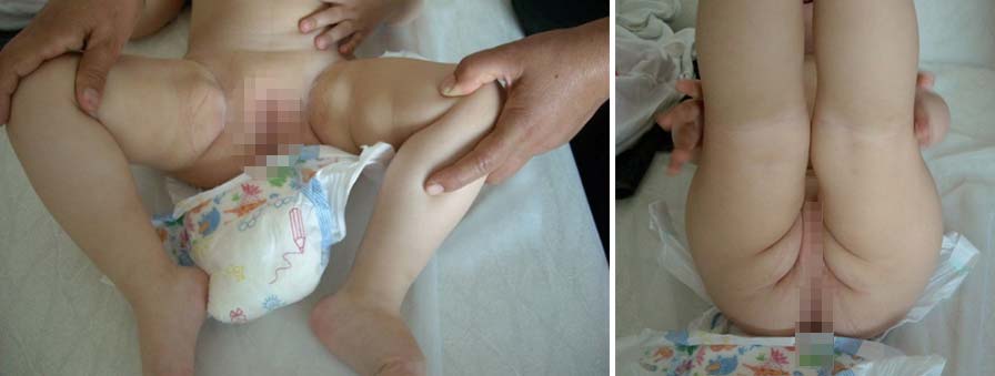 Χειρουργική δυσπλαστικού ισχίου