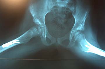 Αναπτυξιακή δυσπλασία του ισχίου