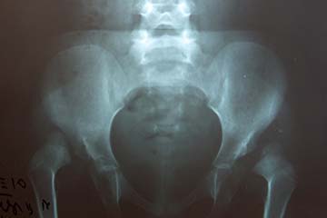 Αναπτυξιακή δυσπλασία του ισχίου