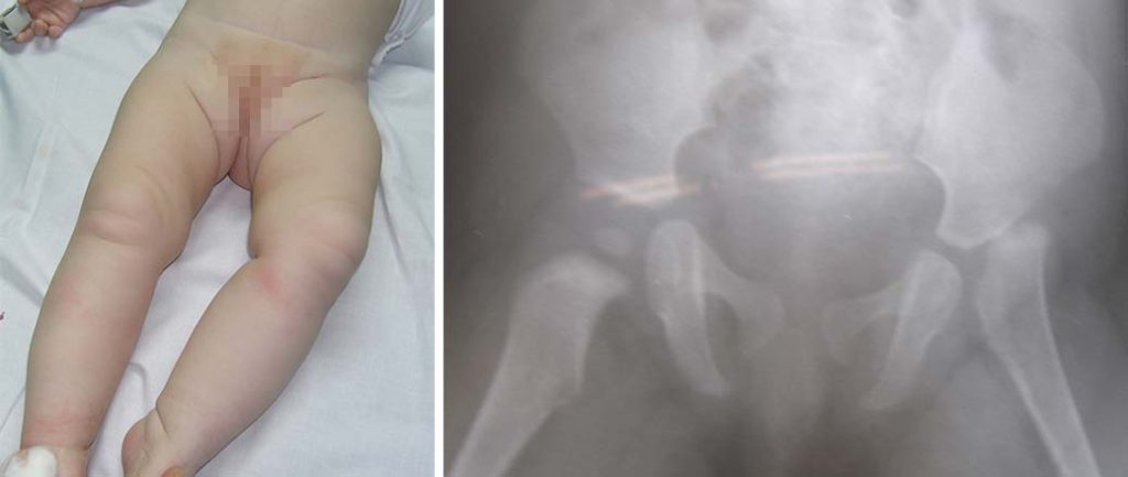 Χειρουργική δυσπλαστικού ισχίου