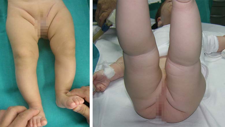 Χειρουργική δυσπλαστικού ισχίου