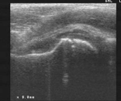 Παροδική υμενίτιδα ισχίου