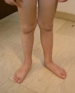 Βάδιση με έσω/έξω στροφή