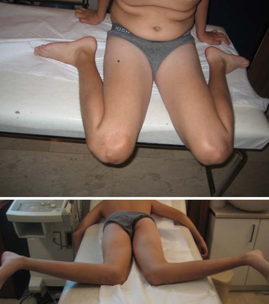 Βάδιση με έσω/έξω στροφή