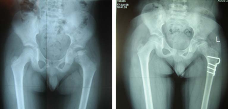 Οστεοχονδρίτιδα μηριαίας κεφαλής - Νόσος Parthes