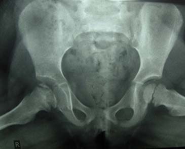 Οστεοχονδρίτιδα μηριαίας κεφαλής - Νόσος Parthes