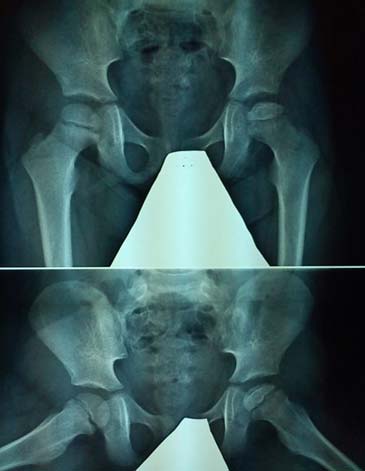 Οστεοχονδρίτιδα μηριαίας κεφαλής - Νόσος Parthes