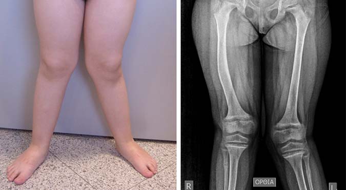 Βλαισογονία