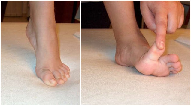 Πλατυποδία