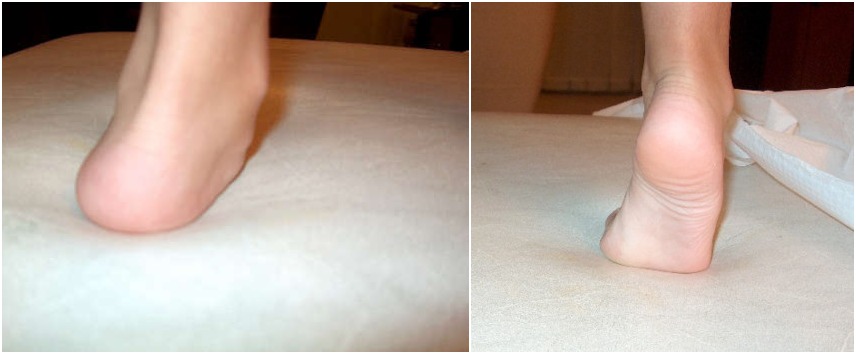 Πλατυποδία