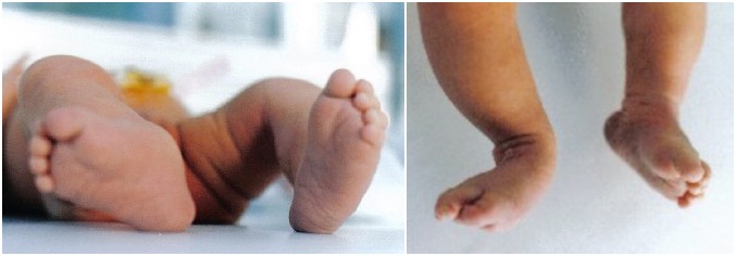 Συγγενής Βλαισότητα πέλματος