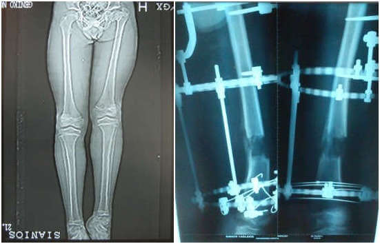 Έλεγχος ανισοσκελιών