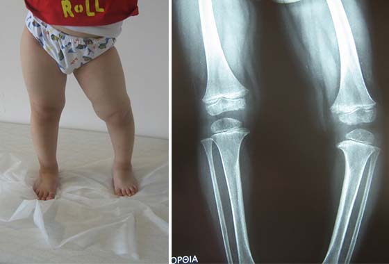 Ραιβογονία - Νόσος Blount