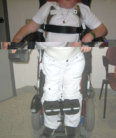 Οστεοπόρωση