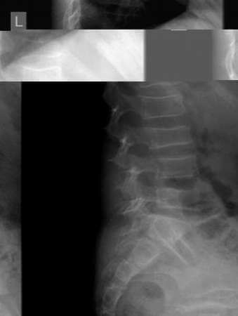 Οστεοπόρωση