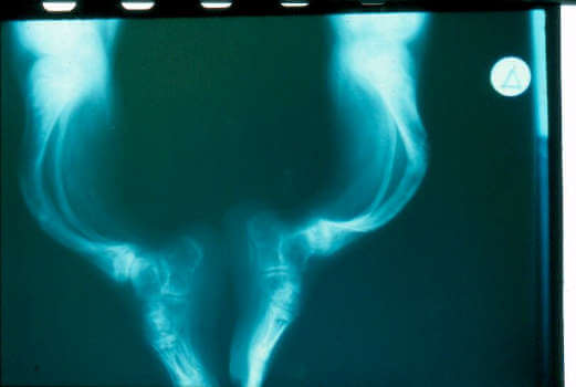 Ατελής οστεογένεση/εύθραυστα οστά