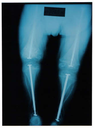 Ατελής οστεογένεση/εύθραυστα οστά