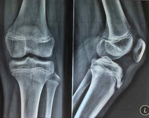 Οστεοχονδρίτιδες