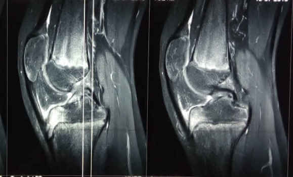 Οστεοχονδρίτιδες