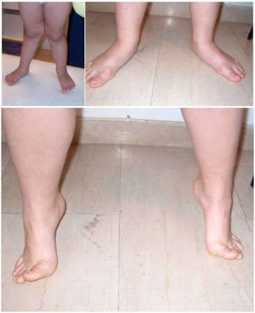 Πλατυποδία