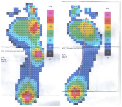 Πλατυποδία