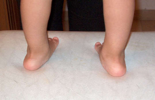 Πλατυποδία