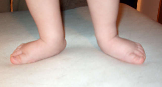 Πλατυποδία