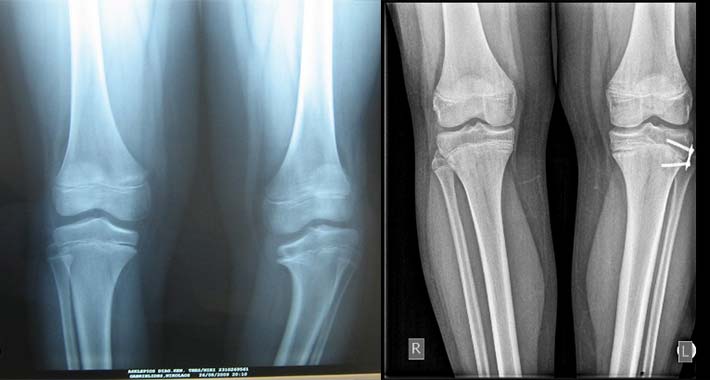 Ραιβογονία - Νόσος Blount