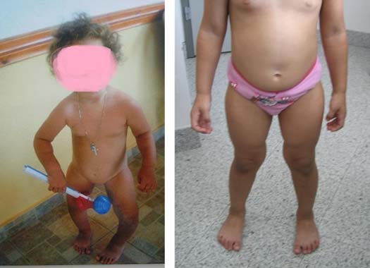 Ραιβογονία - Νόσος Blount