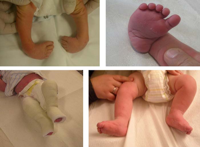 Ραιβοιπποποδία