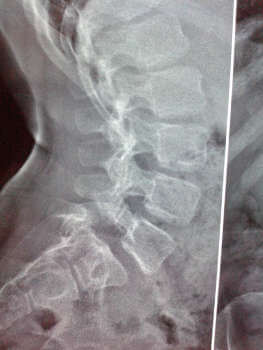 Σπονδυλόλυση – σπονδυλολίσθηση