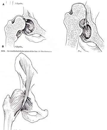 Αναπτυξιακή δυσπλασία του ισχίου