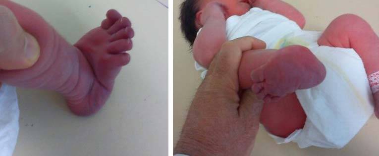 Βλαισότητα άκρου πόδα